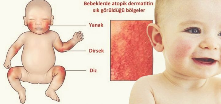 atopik dermatit nedir