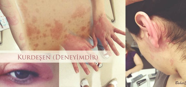 kurdeşen deneyimi