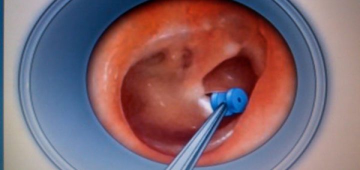 kulak tüpü takılması